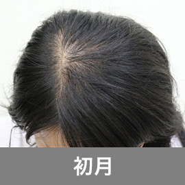 Fagaとは 女性の薄毛治療について 京都 滋賀の大西皮フ科形成外科医院